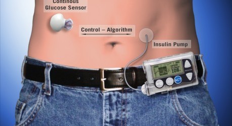 Artificial Pancreas - health news