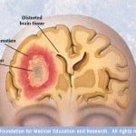 brain tumor 150x150 Study: How To Make Chemotherapy Side Effects Less Deadly