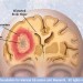 tumor ablation - health news - israel tumor ablation - health news - israel