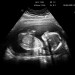 pregnancy stress - health news pregnancy stress - health news