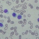 800px Hairy cell leukemia smear 2009 08 20 150x150 Study: How To Make Chemotherapy Side Effects Less Deadly