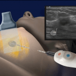 IceCure 150x150 Israeli Technology Turns Tumors Into Ice Balls To Cure Cancer