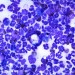 neutrophillic inflammation - health news - cancer