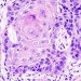 cancer-cells-460x250