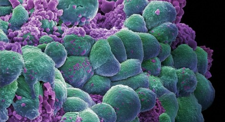 Health News: Researchers Identify Enzyme Which Triggers Cancer