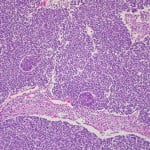 Israeli Scientists Create Heart Pacemaker From Skin Cells wilms tumor 150x150 Israeli Scientists Create Heart Pacemaker From Skin Cells