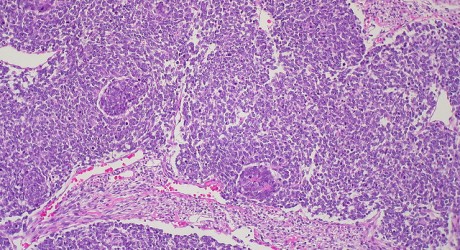 Health News: New Cancer Research May Lead To More Efficient Tumor Treatment