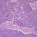 Health News: New Cancer Research May Lead To More Efficient Tumor Treatment