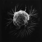 Breast cancer cell 2 150x150 Israeli Technology Turns Tumors Into Ice Balls To Cure Cancer