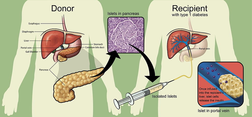 PLoS Medicine Transplantation. Infographic via Giovanni Maki/WikiCommons