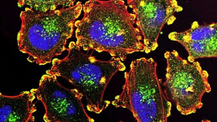 Melanoma Cells. Courtesy of Tel Aviv University