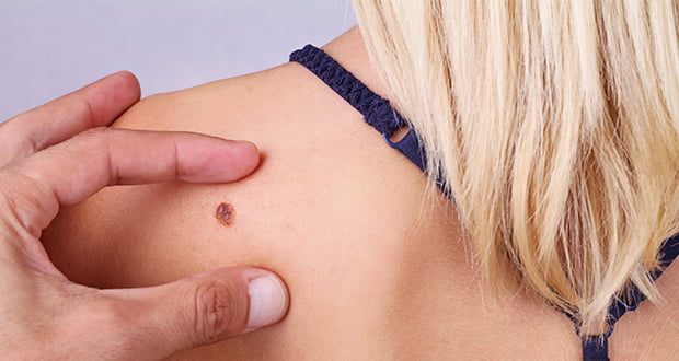 What is Spitzoid melanoma? - RightDiagnosis.com
