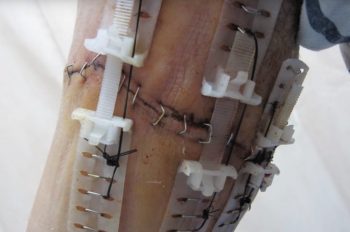 The TopClosure device on a patient's arm. Screenshot