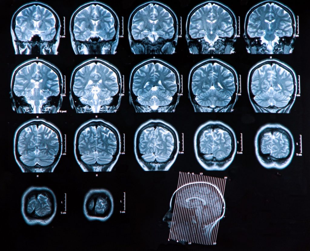 An MRI scan of the human brain. 