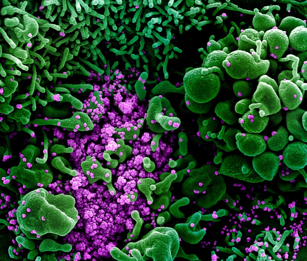 Colorized scanning electron micrograph of an apoptotic cell (green) heavily infected with SARS-COV-2 virus particles (purple), isolated from a patient sample. Image captured and color-enhanced at the NIAID Integrated Research Facility (IRF) in Fort Detrick, Maryland. Credit: NIAID