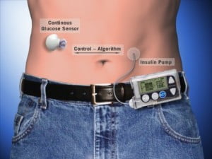 Artificial Pancreas - health news