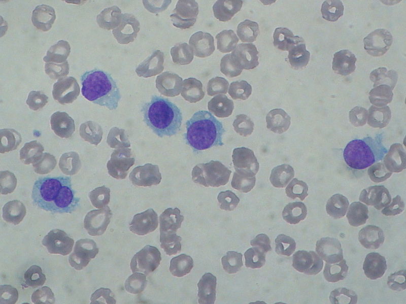 Leukemia cells - Health News - Israel