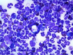 neutrophillic inflammation - health news - cancer