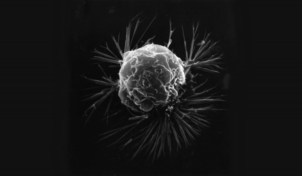 Researchers Find Method For Treating 'Treatment-Resistant' Breast Cancer via National Cancer Institute/Wikimedia