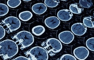 Health News: Study: Common Drug Could Prevent Injury-Related Epilepsy
