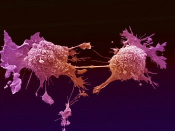 Lung cancer cell dividing. The two daughter cells are only held together by a very thin bridge of cytoplasm. Scanning electron micrograph. Photo by Wellcome Images