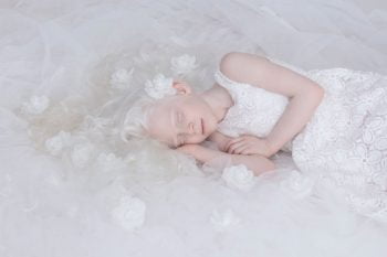 Albino Child Sleeping. Photo by Yulia Taits