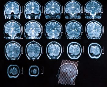 An MRI scan of the human brain