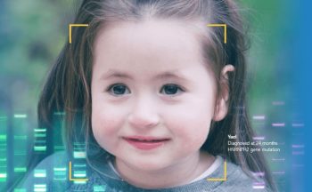 A screenshot from FDNA's website showing the face of a young girl diagnosed at 24 months with the HNRNPH2 gene mutation.