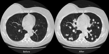 An illustration of a CT scan that was tampered with by the researchers at Ben-Gurion University of the Negev (Courtesy)