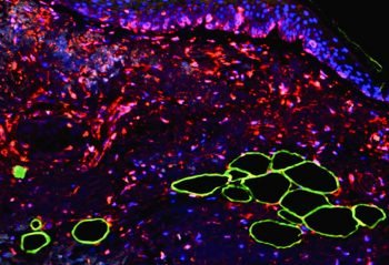 A figure showing immunofluorescence analysis of a patient's melanoma sections, as part of a Tel Aviv University study linking fat cells to the transformation of melanoma cells.