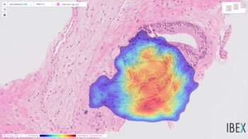 A heatmap view of a previously-missed prostate cancer detected by Ibex's Galen Prostate platform. Courtesy