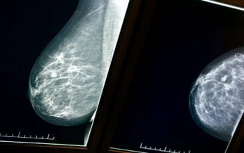 A detailed image of a mammogram. Deposit Photos