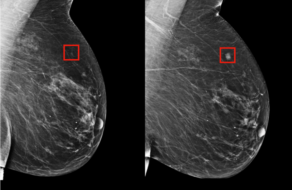 The team's model was shown to be able to identify a woman at high risk of breast cancer four years (left) before it developed (right). Photo: MIT CSAIL