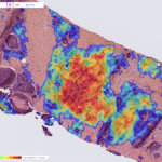 Breast cancer detected by Ibex’s Galen Breast AI solution - the tumor is marked with a heatmap. Courtesy