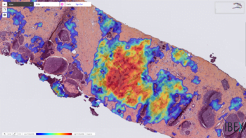 Breast cancer detected by Ibex’s Galen Breast AI solution - the tumor is marked with a heatmap. Courtesy