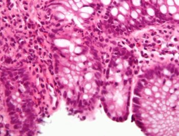 A high magnification micrograph of cryptitis in a case of Crohn's disease. By Nephron - Own work, CC BY-SA 3.0, https://commons.wikimedia.org/w/index.php?curid=8697328