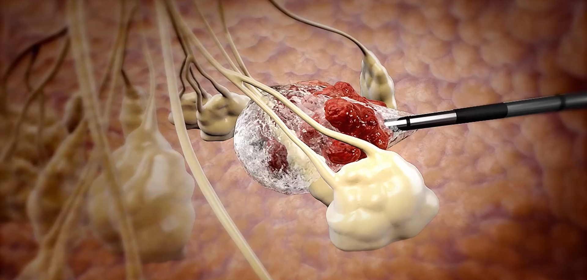 Painless Procedure Tiny Ice Ball Kills Tumors In Minutes