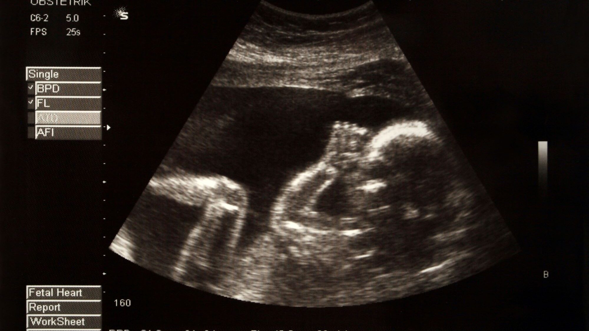 Малыш на 21 неделе беременности. УЗИ плода на 23 неделе беременности. УЗИ малыша на 23 неделе беременности. Снимки УЗИ. Фотоснимок с УЗИ ребенка.