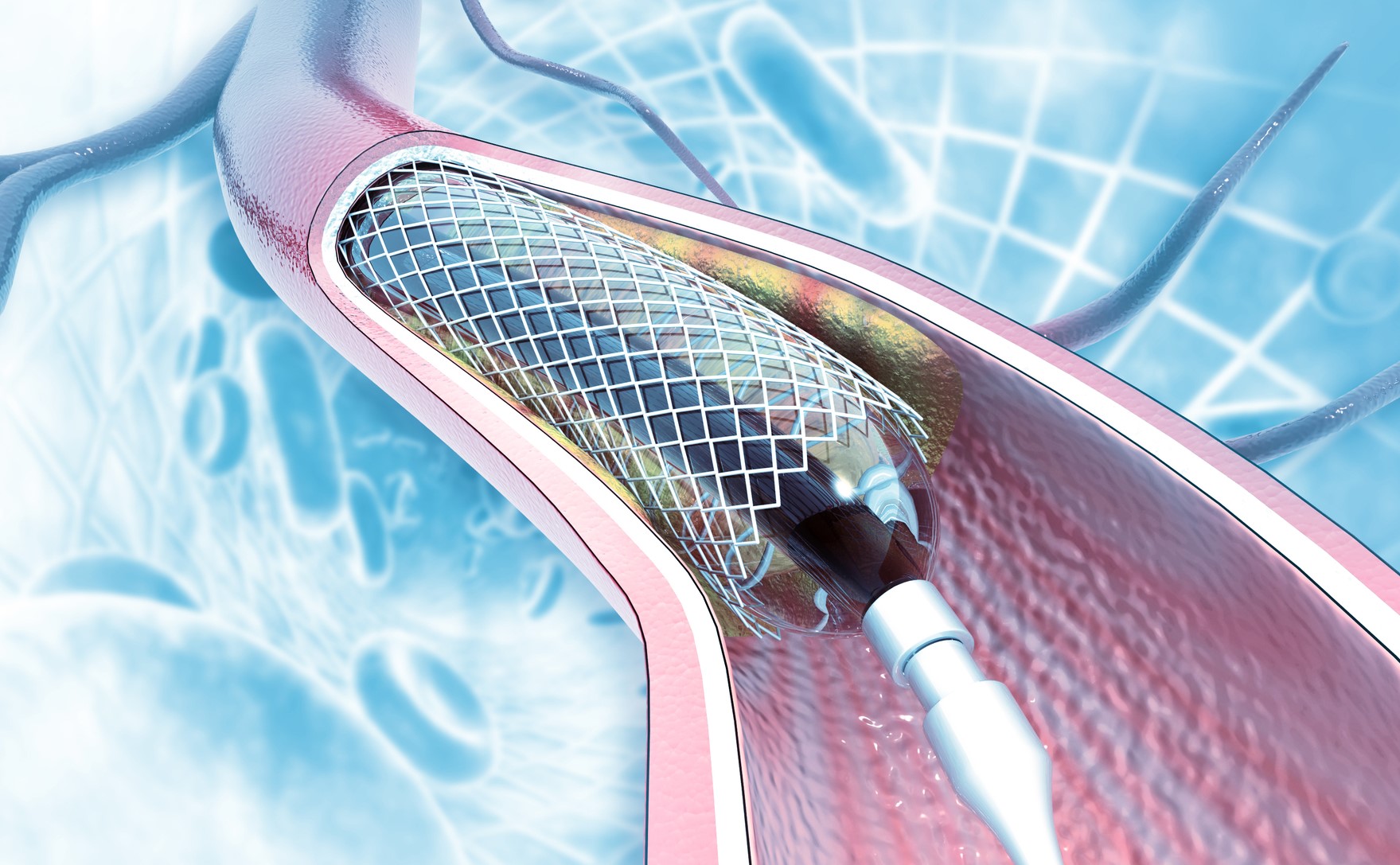 ‘Virtual Stent’ Uses Sound Waves To Boost Leg Artery Blood Flow